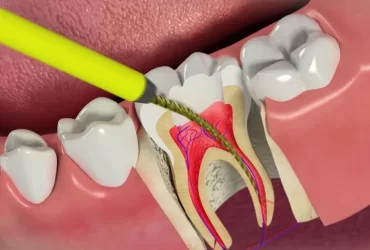 عصب‌ کشی دندان