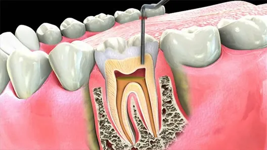 عصب‌ کشی دندان