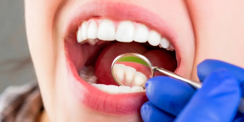 کامپوزیت دندان به هم ریخته