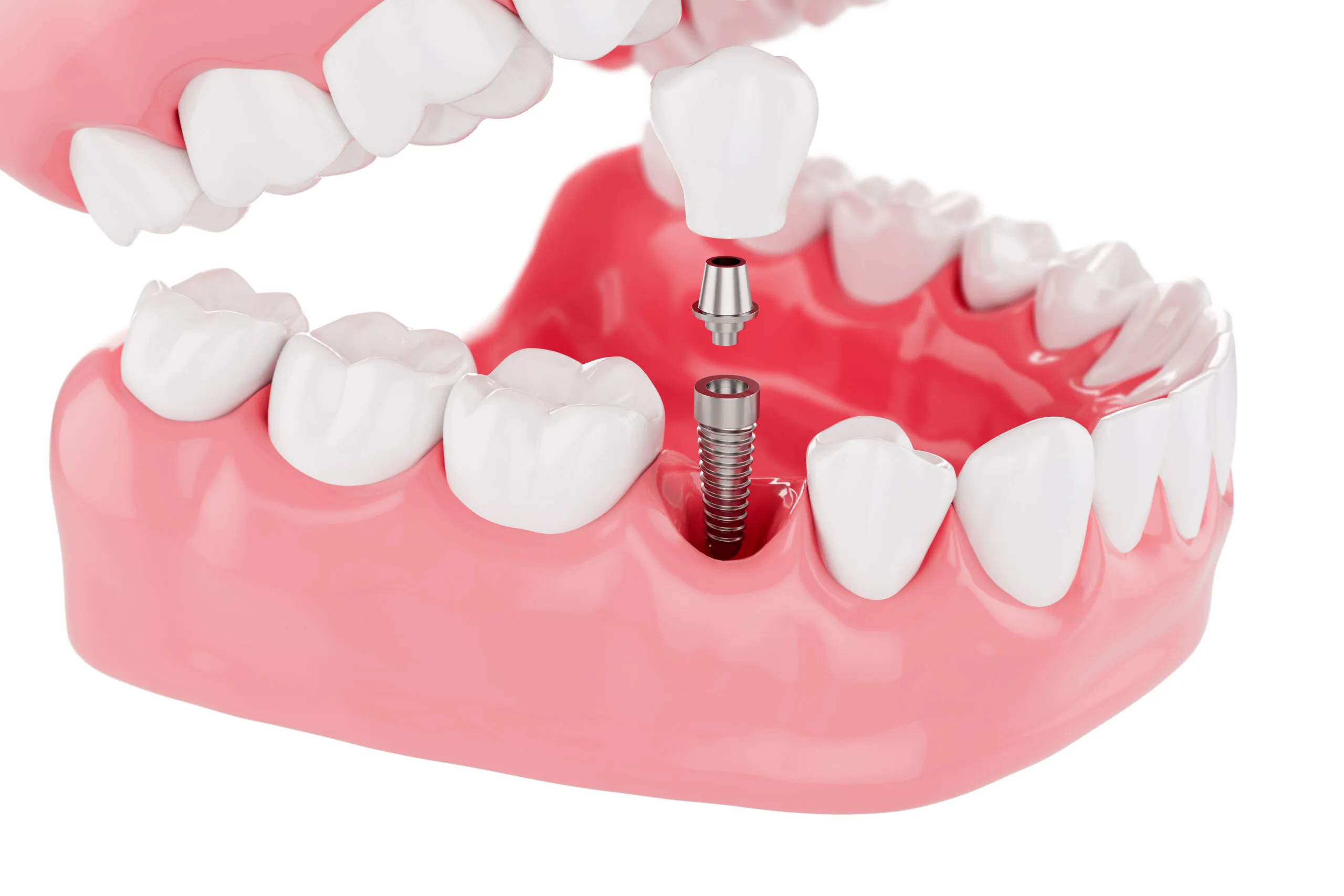 سخت ترین مرحله ایمپلنت دندانی چیست؟