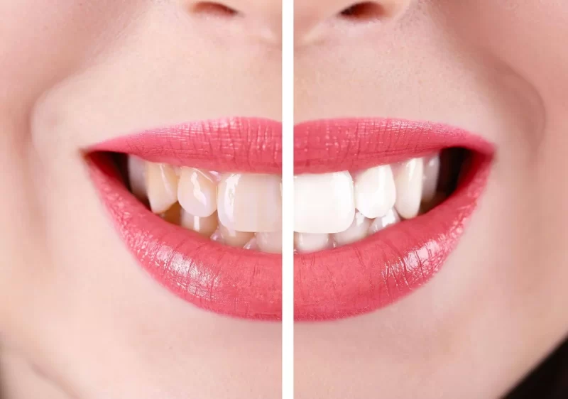 کامپوزیت دندان رنگ طبیعی