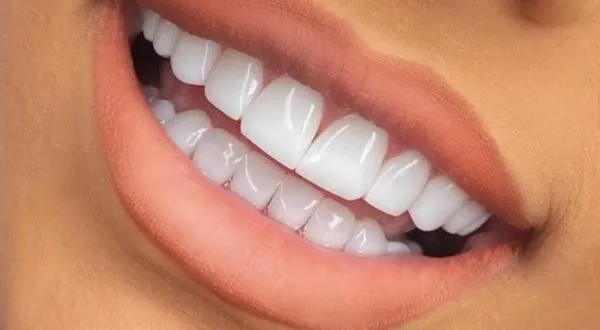 کامپوزیت دندان رنگ سفید یخچالی
