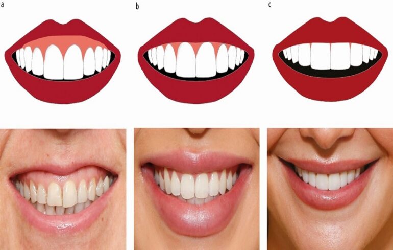 کاربرد بوتاکس برای درمان کوتاهی طول تاج دندان