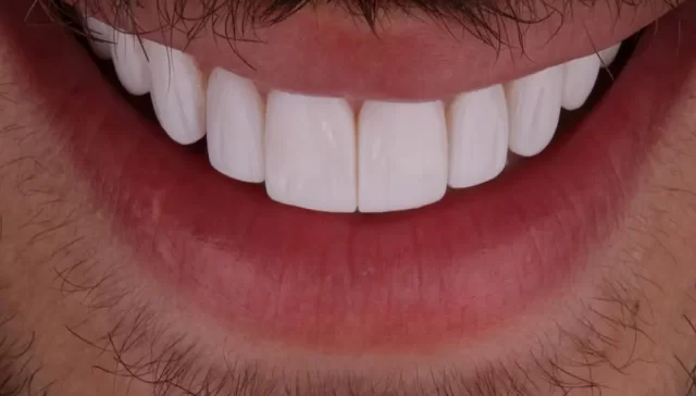 تفاوت لمینت و کامپوزیت دندان