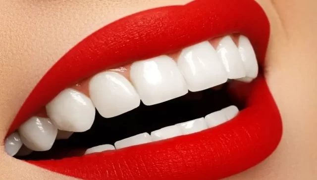 لمینت دندان