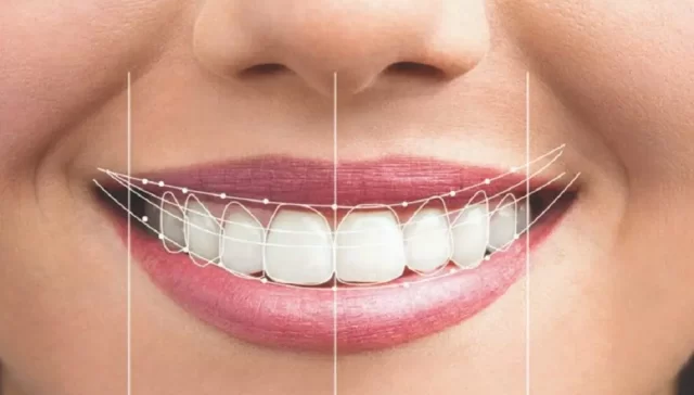 بهترین لمینیت دندان در اختیاریه